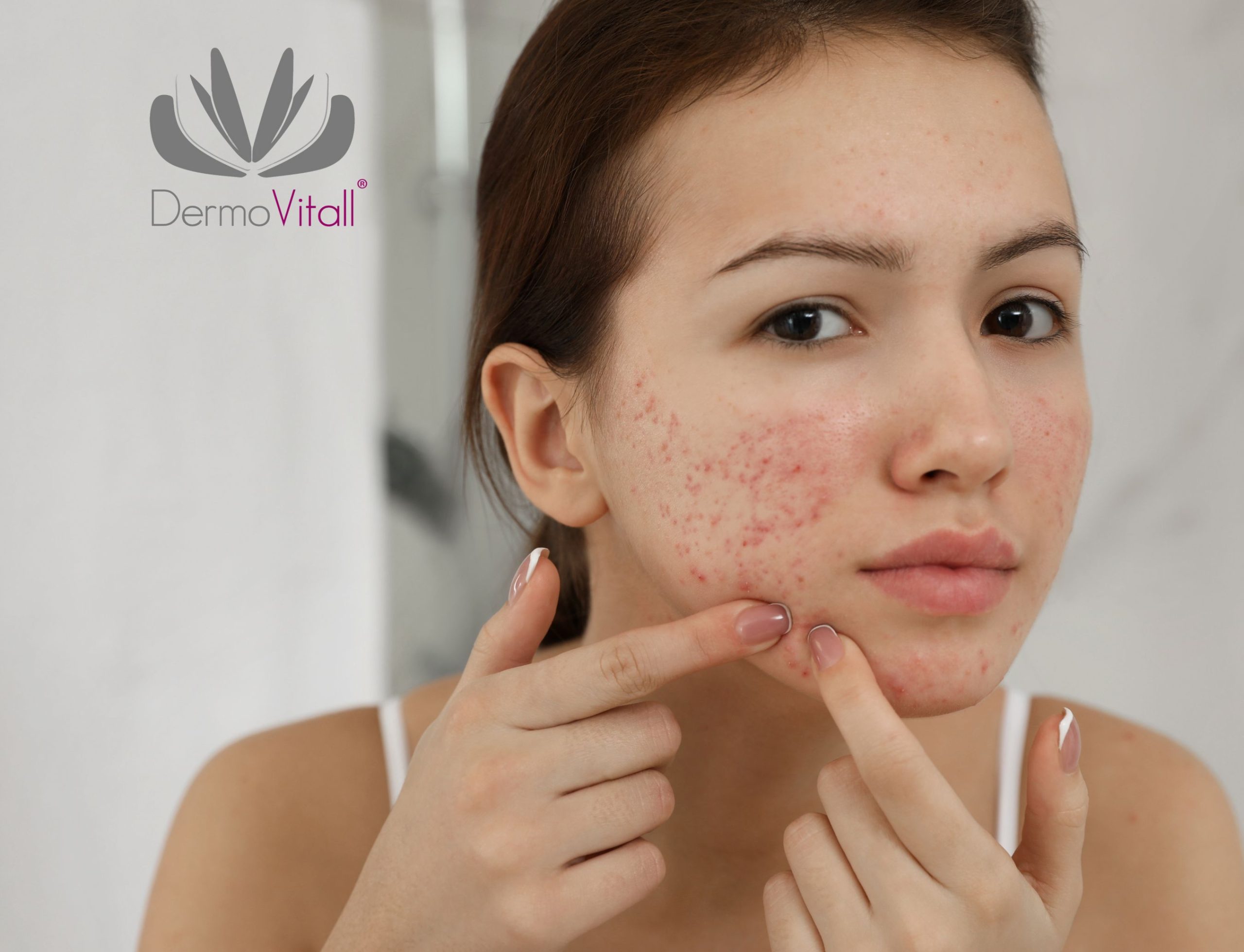 Cómo resarcir los daños por el acne