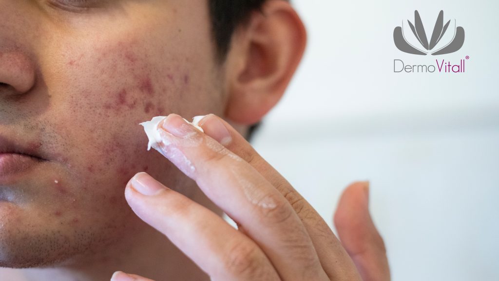 Más allá de la dermatología: descubre quiénes pueden ayudarte a eliminar el acné. 