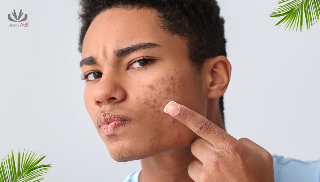 Acne en diferentes etapas de la vida