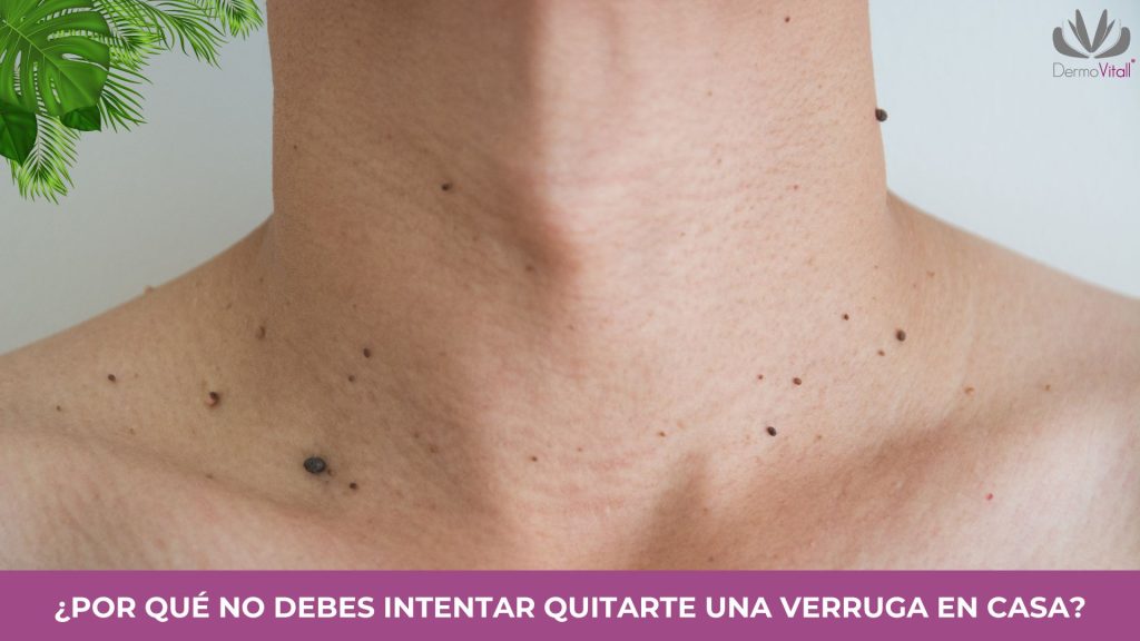 Verrugas