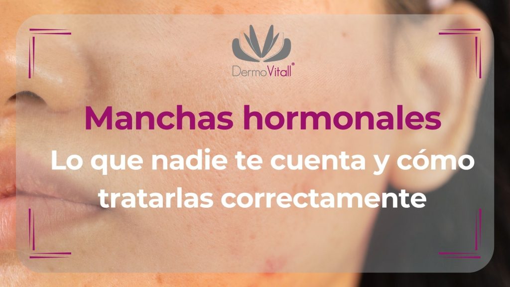 Manchas Hormonales